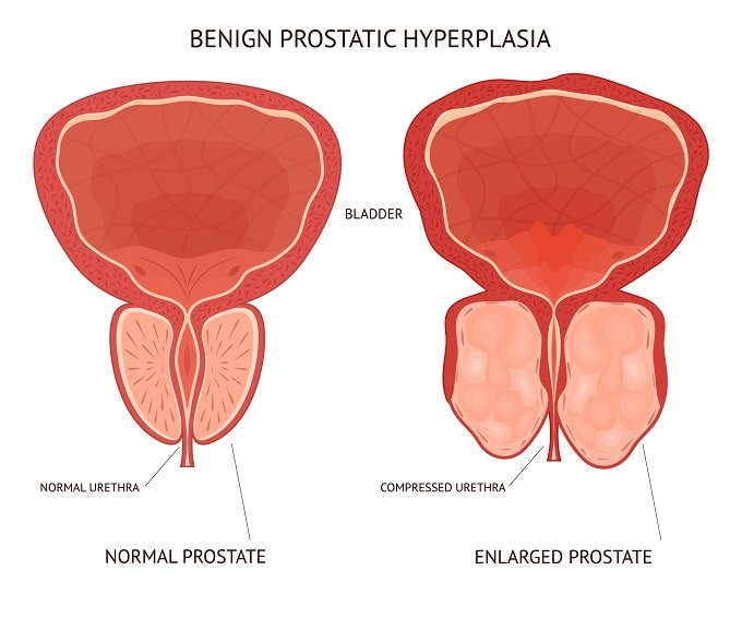 An enlarged prostate benign prostatic hypertrophy (BPH)